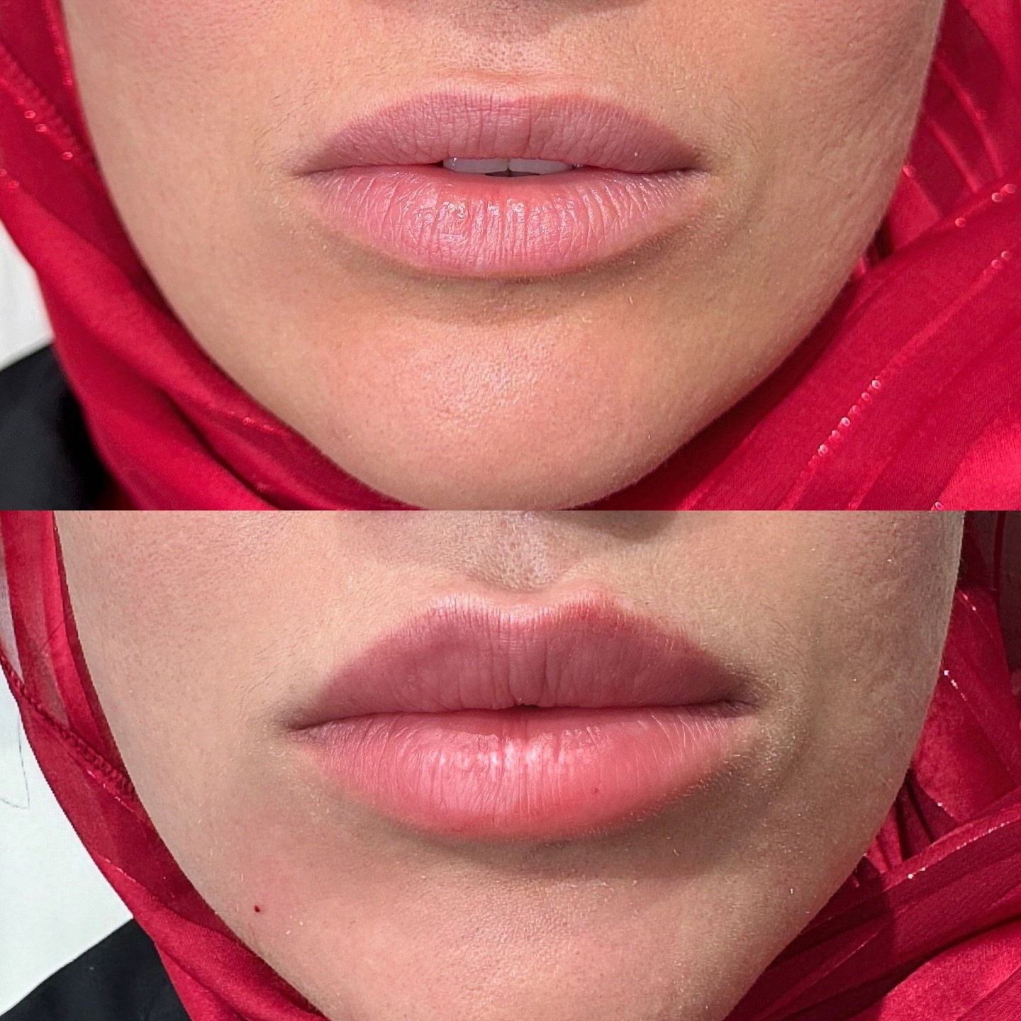 PERFECT LIPS COMES FROM @addbeautymedspa 
.
.
.
.
Undetectable lip fillers with the lip king 👑 
0.7 ml was used total. 
#undectablefillers 
#lipking
#naturallips 
#lipfiller